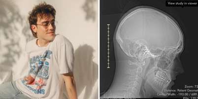 Jake Luppen anunciou que fará cirurgia para retirar tumor cerebral e ficará acordado durante procedimento Foto: Reprodução/Instagram